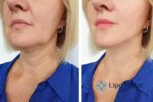 Book your double chin treatment Shipston on Stour today! We are here to help!