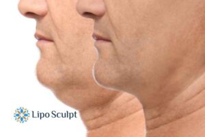 Double chin treatment Shipston on Stour from Lipo Sculpt - feel more confident today!