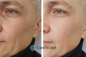 Fight Aging Symptoms Shipston on Stour With HIFU and Morpheus8 Today!