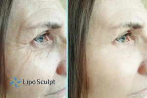 Do you want to Fight Aging Symptoms Shipston on Stour? Contact Lipo Sculpt today!