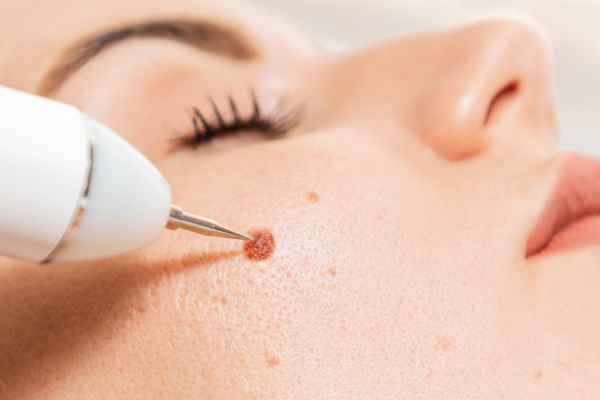 CryoPen: 5 Skin Concerns It May Be Used to Treat 3 What actually happens during a CryoPen treatment Shipston on Stour?