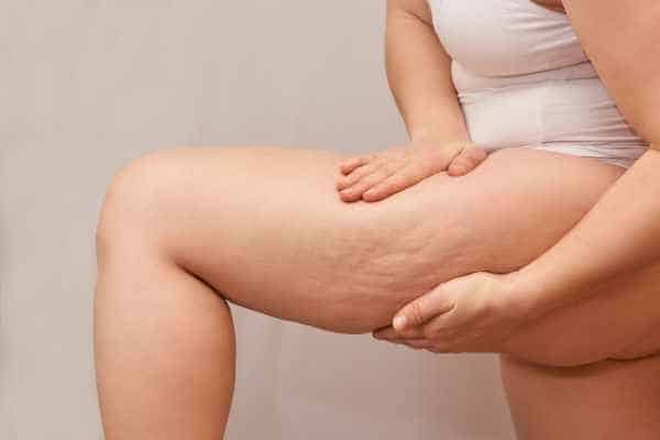 Find the best cellulite treatment Shipston on Stour for you!