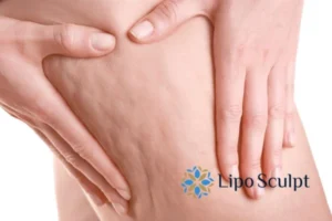 Start your journey today book your coolsculpting treatment Shipston on Stour online today!