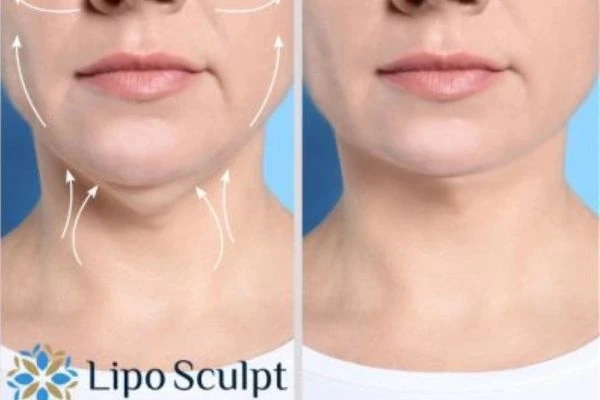 Book your Chin Reduction Treatment Shipston on Stour today! Call Lipo Sculpt NOW!
