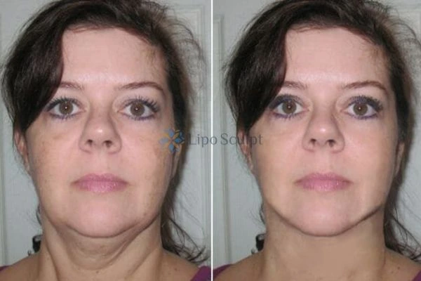 Chin Reduction Treatment Shipston on Stour - Aqualyx treatment