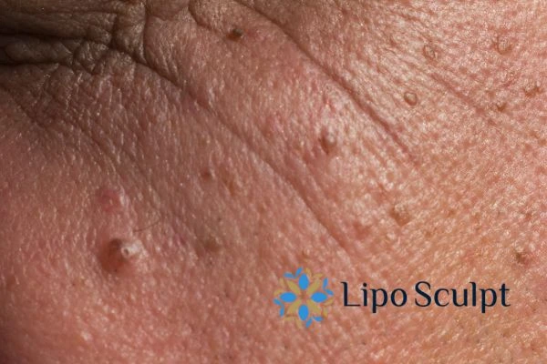 Remove skin lesions in as little as one treatment for an anti ageing Shipston on Stour effect!