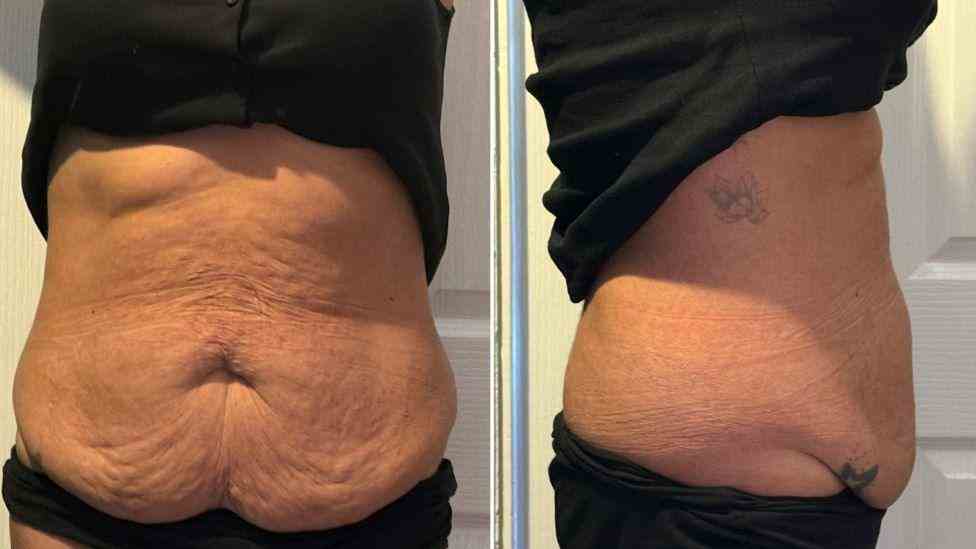 Lost the Weight but Not the Loose Skin? What You Should Know 1 Is It Definitely Loose Skin Shipston on Stour?