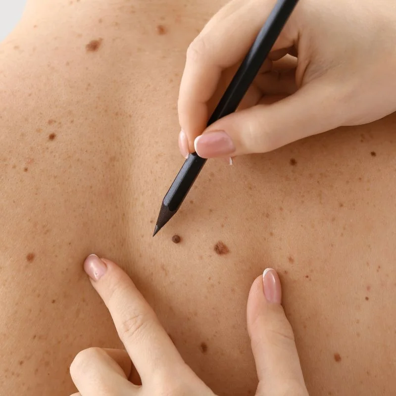 cryopen lesion removal treatment Shipston on Stour